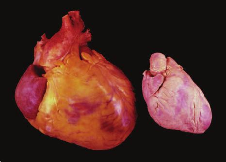 severe cardiomegaly with dilatation.